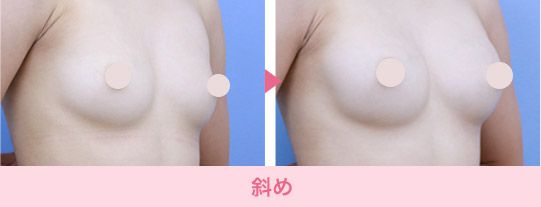 豊胸 バストの修正なら湘南美容クリニック 公式 美容整形 美容外科