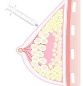 脂肪を注入