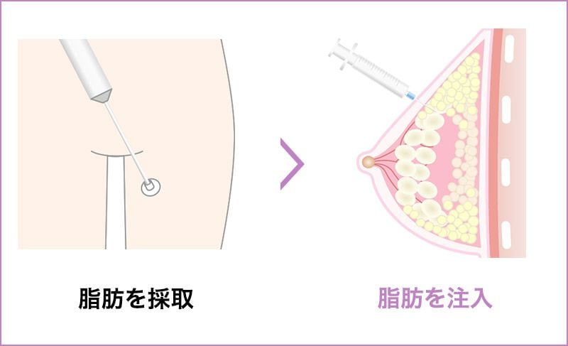 脂肪を採取して注入