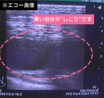 しこりの修正