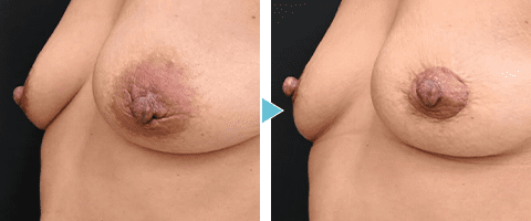 乳輪縮小術の症例写真