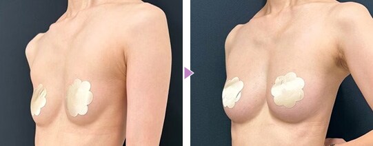 痩せ型の脂肪注入豊胸の症例