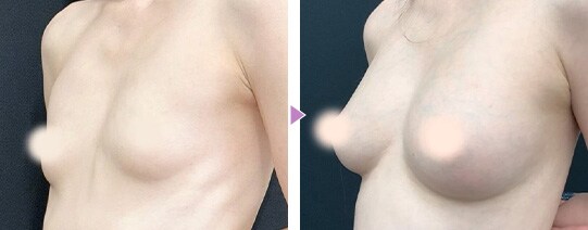 痩せ型の脂肪注入豊胸の症例