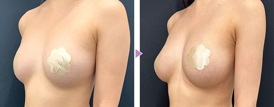 理想のボディを追求 脂肪注入豊胸の症例