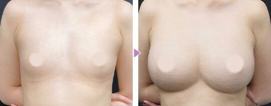 理想のボディを追求 脂肪注入豊胸の症例