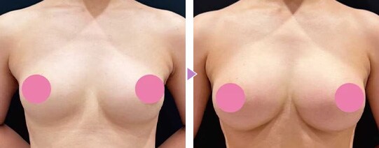 理想のボディを追求 脂肪注入豊胸の症例