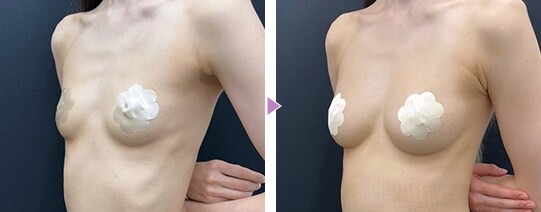 理想のボディを追求 脂肪注入豊胸の症例