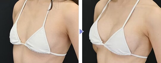 CEREFORM®（セレフォーム）症例写真