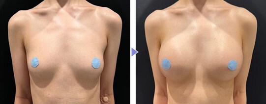 CEREFORM®（セレフォーム）症例写真