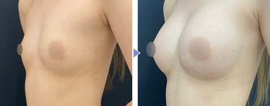 MESMO（メスモ）症例写真