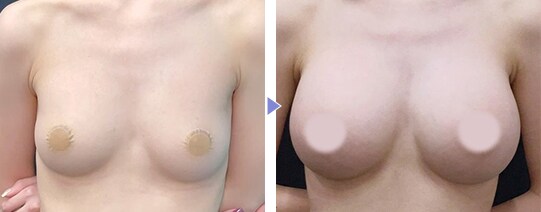 MESMO（メスモ）症例写真