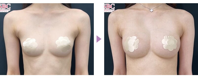 脂肪注入豊胸のピックアップ症例