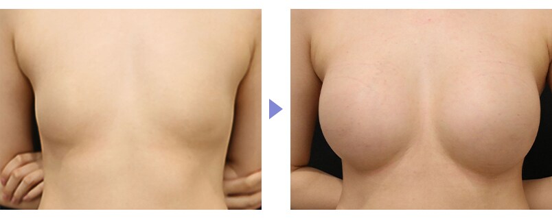 シリコンバッグ豊胸のピックアップ症例