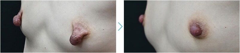 乳輪・乳頭・バスト吊り上げ