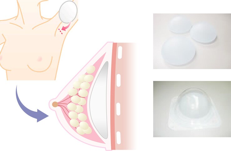 脂肪注入豊胸の施術方法