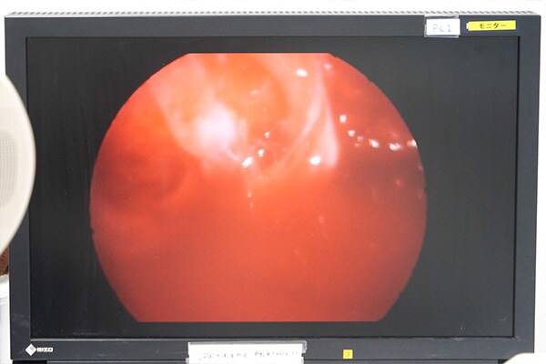 内視鏡下バッグ豊胸とは イメージ3