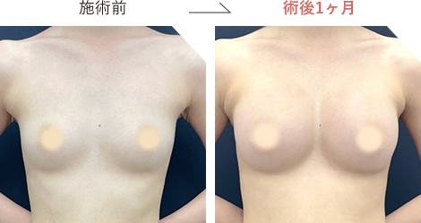 ハイブリッド豊胸の症例写真施術前後2