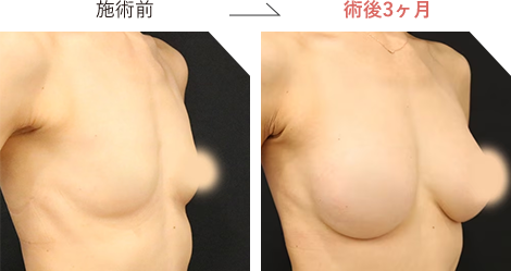 ハイブリッド豊胸の症例写真施術前後3