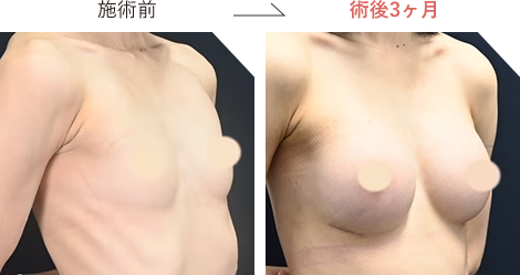 ハイブリッド豊胸の症例写真施術前後4