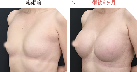 ハイブリッド豊胸の症例写真施術前後5