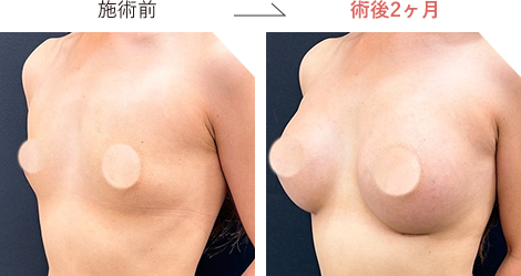ハイブリッド豊胸の症例写真施術前後6