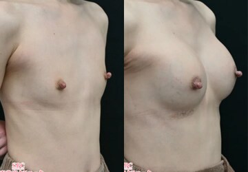MESMO(メスモ)バッグ豊胸術から1か月後の症例写真