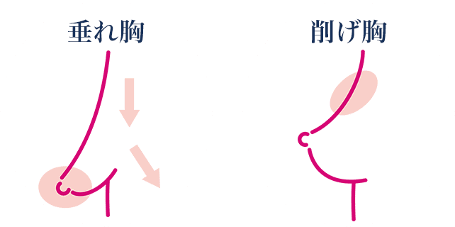 垂れ胸と削げ胸のイラスト