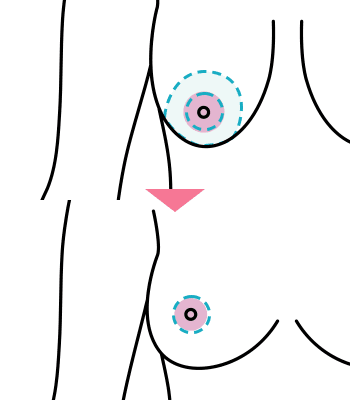 乳房縮小術Goes法