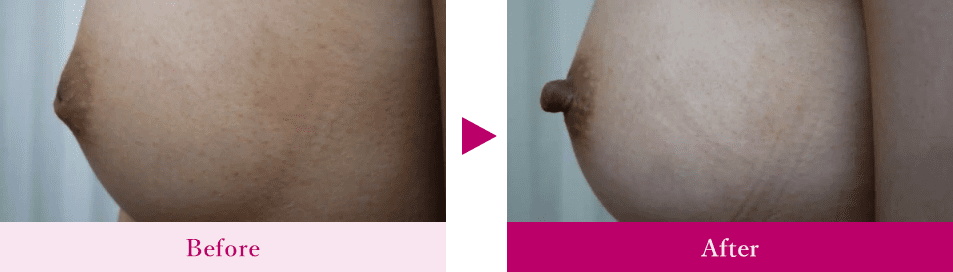MAX脂肪幹細胞注入＋左陥没乳頭治療術1か月後