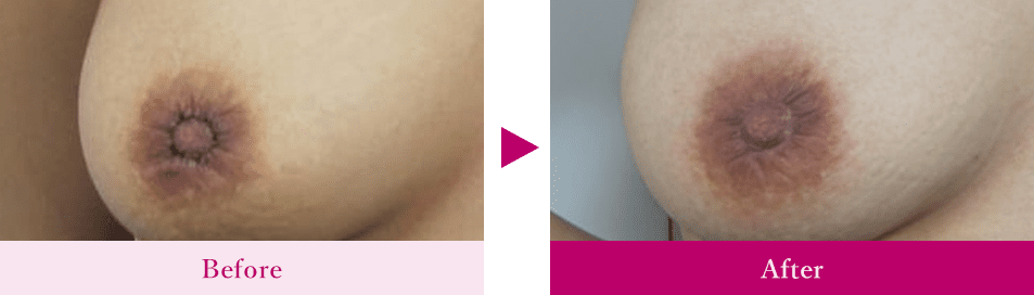 乳輪縮小術内側縫縮法手術後1か月