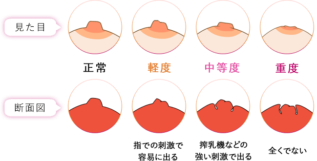 陥没乳頭治療とは