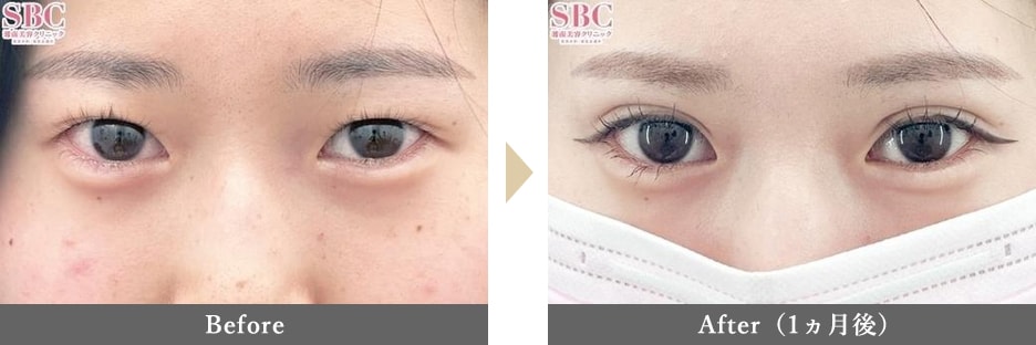 二重整形の症例写真 Before After 1ヵ月後