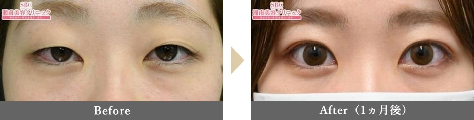 二重整形の症例写真 Before After 1ヵ月後