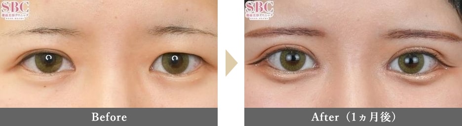 二重整形の症例写真 Before After 1ヵ月後