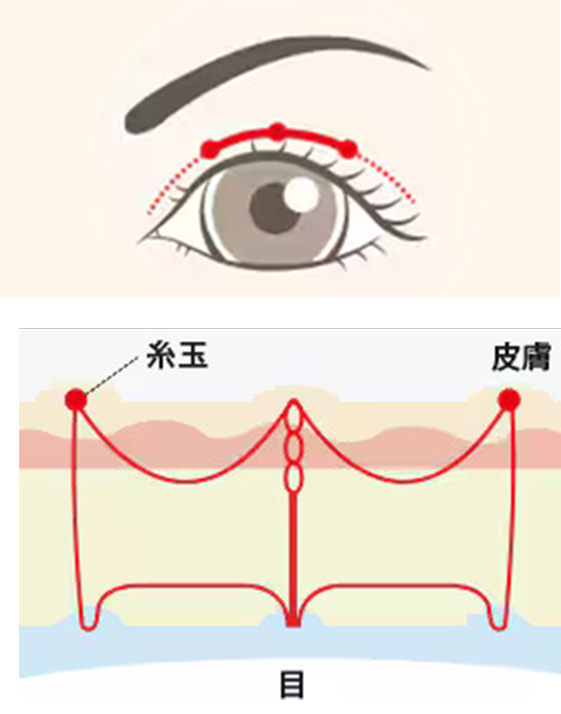 フォーエバー二重術の施術イメージ