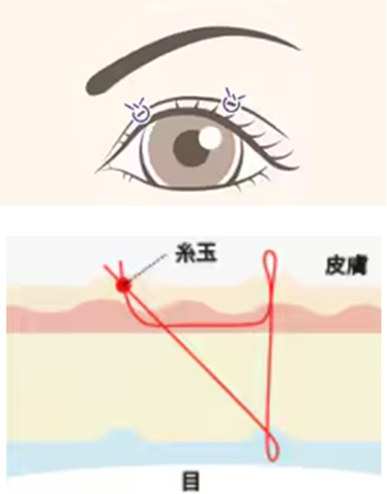 週末二重術の施術イメージ