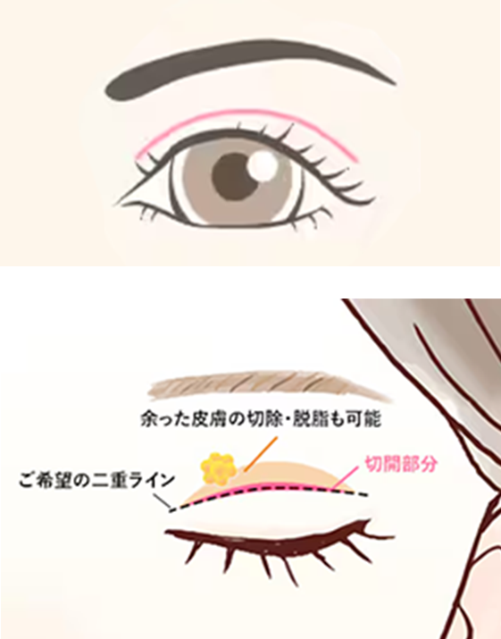 全切開二重術の施術イメージ