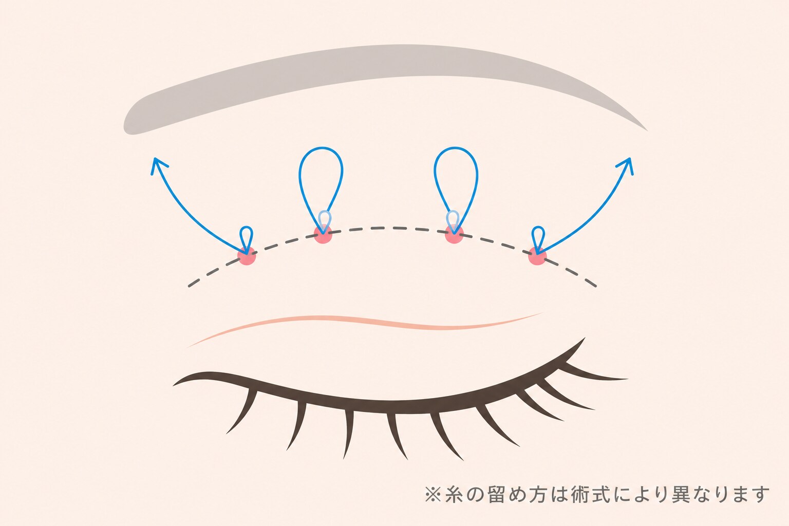 二重整形 埋没法のイメージ