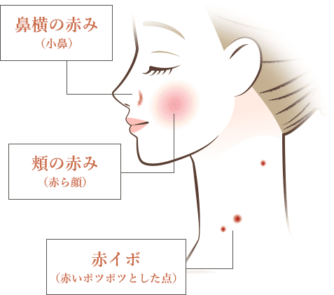 鼻横の赤み（小鼻）、頬の赤み（赤ら顔）、赤イボ（赤いボツボツとした点）