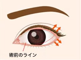 目尻切開法のデザイン