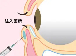 涙袋ヒアルロン酸