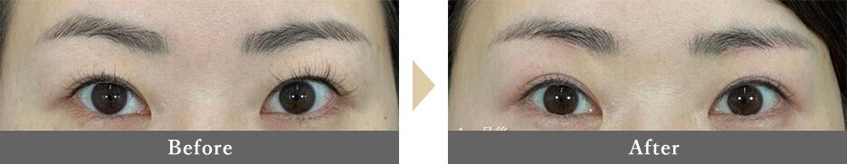 眉下切開の症例写真 Before After 1ヵ月後