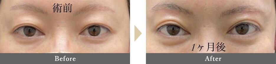 眉下切開（眉下リフト）の症例写真 Before After 1ヵ月後