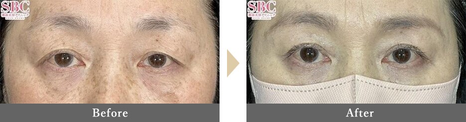 眉下切開（眉下リフト）の症例写真 Before After 3ヵ月後