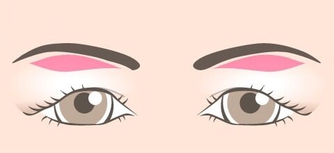 余剰皮膚を削除