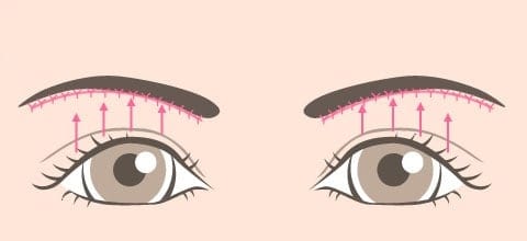 眉下ラインに沿って縫合