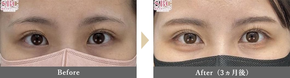 目頭切開の症例写真 Before After 3ヵ月後