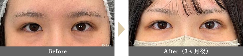 目頭切開の症例写真 Before After 3ヵ月後