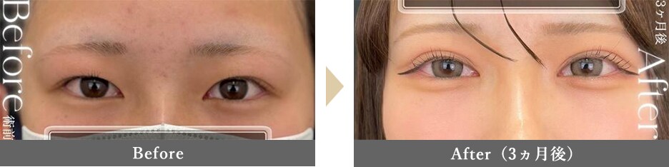 目頭切開の症例写真 Before After 3ヵ月後