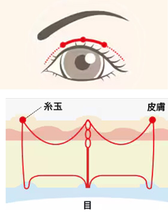 フォーエバー二重術®のデザイン